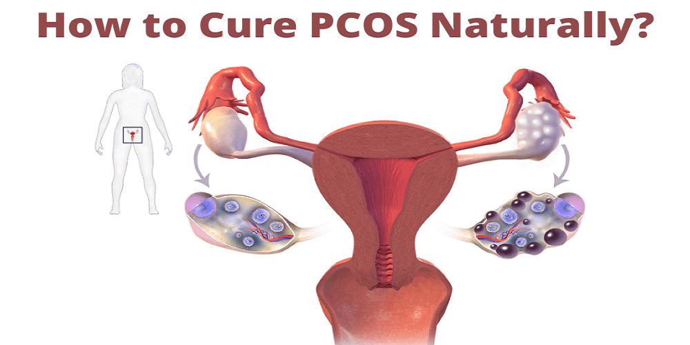 Cure PCOS Naturally Best Ways Healthmania